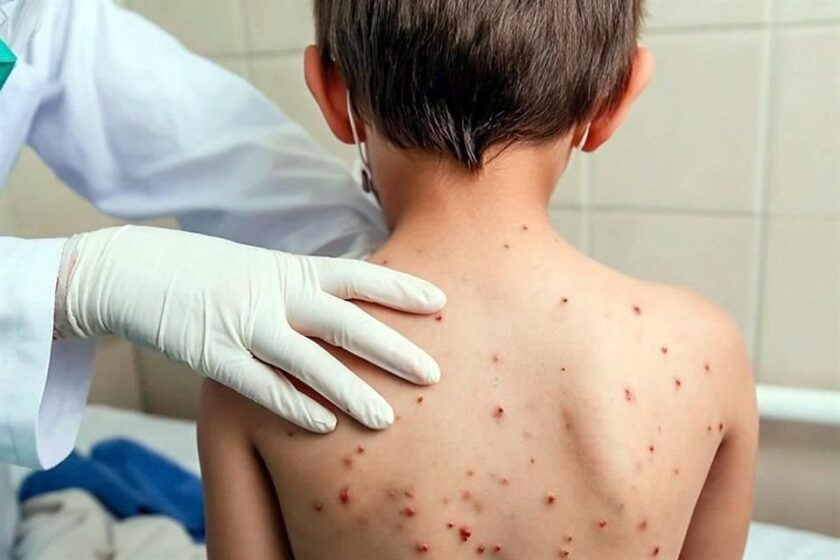 PREOCUPACIÓN  EN CHAJARÍ POR EL SARAMPIÓN