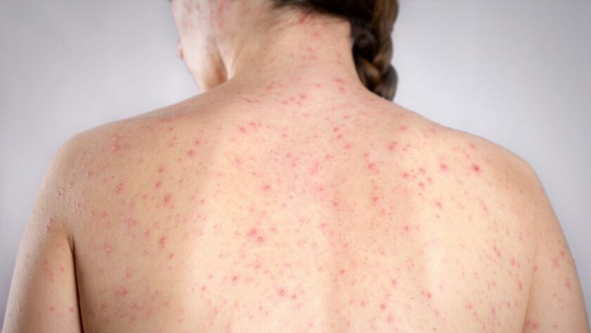 REPORTARON UN CASO SOSPECHOS DE SARAMPIÓN EN FEDERACIÓN